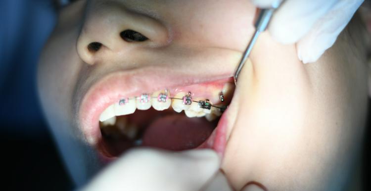 A close up of a mouth, teeth with braces on, being examined by a dentist.